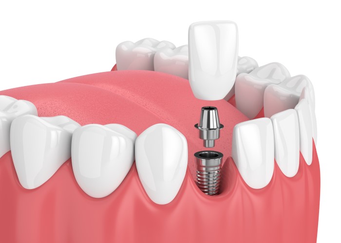 dental implant diagram