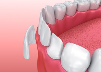 dental veneers diagram